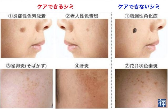 キャッシュ 健康的 硫黄 肝 斑 に 効く 化粧品 Tokyo Jonan Jp