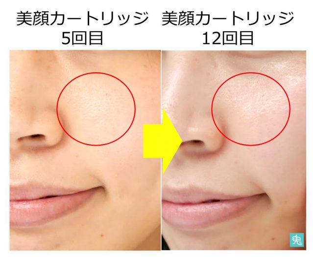 ケノン美顔器3ヶ月使ったシミ・毛穴の効果は？ほくろ・火傷の口コミレビュー | 家庭用脱毛器の鬼